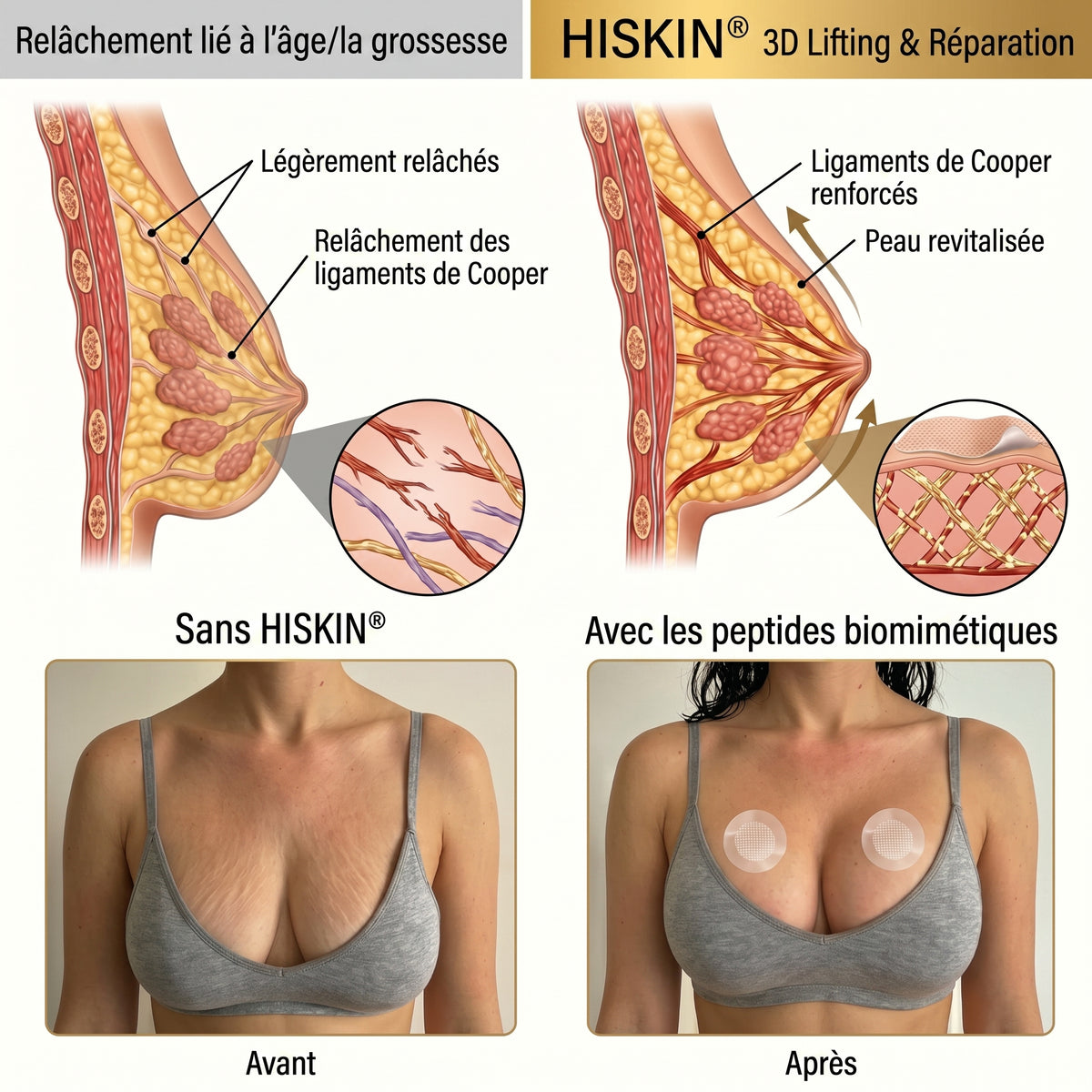 HISKIN® 👩‍⚕️ Patch Ciblé Avancé à Nano Micro-Aiguilles pour le Rehaussement de la Poitrine